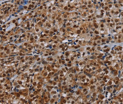 Immunohistochemistry of paraffin-embedded Human thyroid cancer tissue using DCAF6 Polyclonal Antibody at dilution 1:30