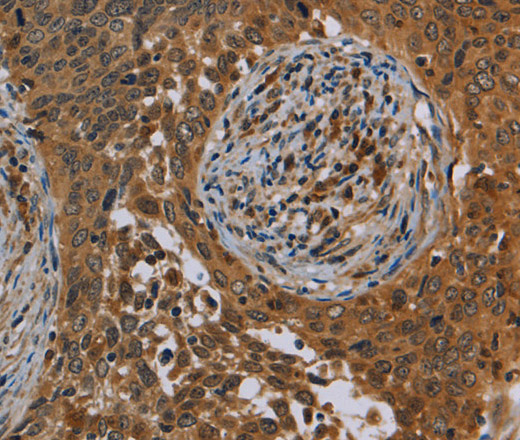 Immunohistochemistry of paraffin-embedded Human cervical cancer tissue using OSM Polyclonal Antibody at dilution 1:40