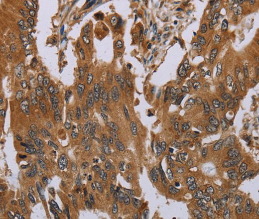 Immunohistochemistry of paraffin-embedded Human colon cancer tissue using OSM Polyclonal Antibody at dilution 1:40