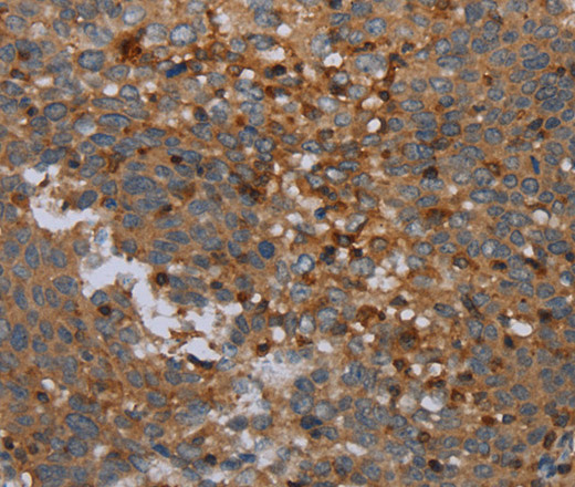Immunohistochemistry of paraffin-embedded Human cervical cancer tissue using OTOR Polyclonal Antibody at dilution 1:30