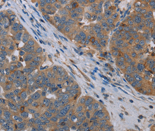 Immunohistochemistry of paraffin-embedded Human ovarian cancer tissue using OTOR Polyclonal Antibody at dilution 1:30