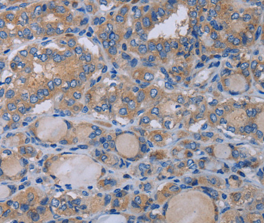 Immunohistochemistry of paraffin-embedded Human thyroid cancer using P2RX3 Polyclonal Antibody at dilution of 1:50