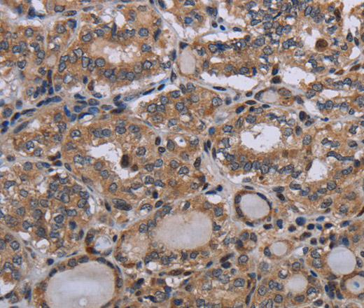 Immunohistochemistry of paraffin-embedded Human thyroid cancer using P2RX2 Polyclonal Antibody at dilution of 1:50