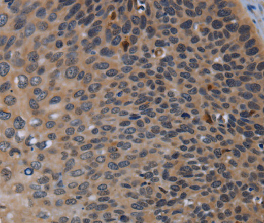 Immunohistochemistry of paraffin-embedded Human cervical cancer using P2RX2 Polyclonal Antibody at dilution of 1:50