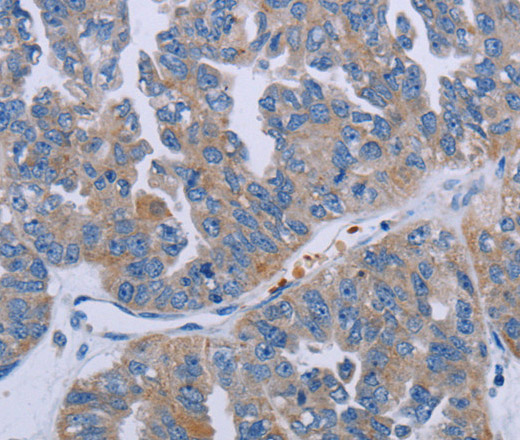 Immunohistochemistry of paraffin-embedded Human ovarian cancer tissue using P2RY2 Polyclonal Antibody at dilution of 1:40