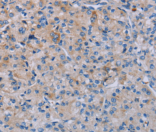 Immunohistochemistry of paraffin-embedded Human prostate cancer using P2RY2 Polyclonal Antibody at dilution of 1:40