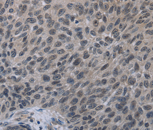 Immunohistochemistry of paraffin-embedded Human lung cancer tissue using TP53AIP1 Polyclonal Antibody at dilution 1:50