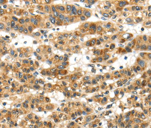 Immunohistochemistry of paraffin-embedded Human ovarian cancer tissue using PAPPA Polyclonal Antibody at dilution of 1:50