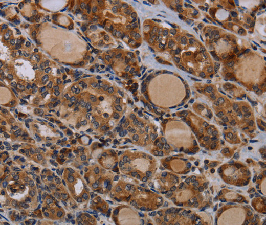 Immunohistochemistry of paraffin-embedded Human thyroid cancer using PAPPA Polyclonal Antibody at dilution of 1:50