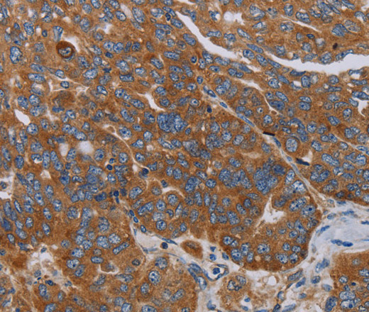 Immunohistochemistry of paraffin-embedded Human ovarian cancer tissue using PARP10 Polyclonal Antibody at dilution 1:30