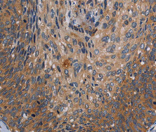 Immunohistochemistry of paraffin-embedded Human cervical cancer tissue using PARP10 Polyclonal Antibody at dilution 1:30