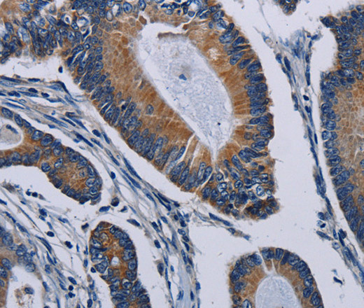 Immunohistochemistry of paraffin-embedded Human colon cancer tissue using PCDHAC2 Polyclonal Antibody at dilution 1:50