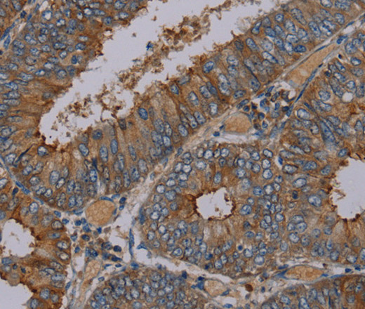 Immunohistochemistry of paraffin-embedded Human colon cancer tissue using PYY Polyclonal Antibody at dilution 1:30