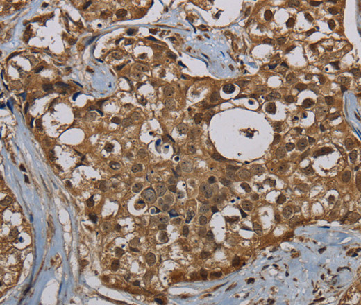 Immunohistochemistry of paraffin-embedded Human breast cancer tissue using PNN Polyclonal Antibody at dilution 1:50