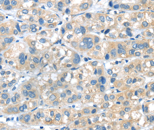 Immunohistochemistry of paraffin-embedded Human liver cancer tissue using PLXNA2 Polyclonal Antibody at dilution 1:40