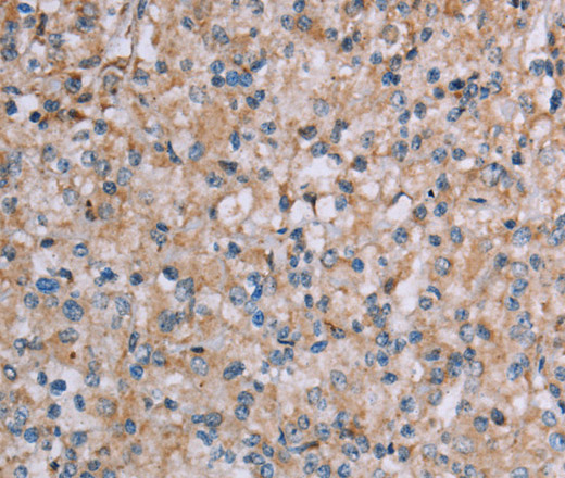 Immunohistochemistry of paraffin-embedded Human prostate cancer tissue using PLXNA4 Polyclonal Antibody at dilution 1:50