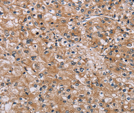 Immunohistochemistry of paraffin-embedded Human prostate cancer tissue using POMT1 Polyclonal Antibody at dilution 1:40