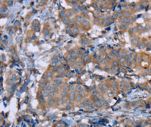 Immunohistochemistry of paraffin-embedded Human breast cancer using PON1 Polyclonal Antibody at dilution of 1:40