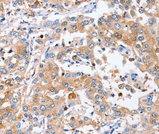 Immunohistochemistry of paraffin-embedded Human liver cancer tissue using PPOX Polyclonal Antibody at dilution 1:40