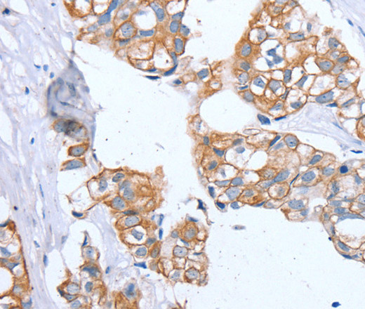 Immunohistochemistry of paraffin-embedded Human breast cancer using PTP4A2 Polyclonal Antibody at dilution of 1:30