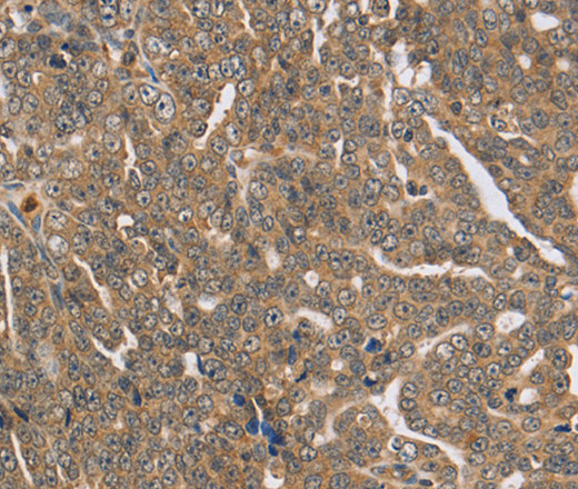 Immunohistochemistry of paraffin-embedded Human cervical cancer using PTPN12 Polyclonal Antibody at dilution of 1:45