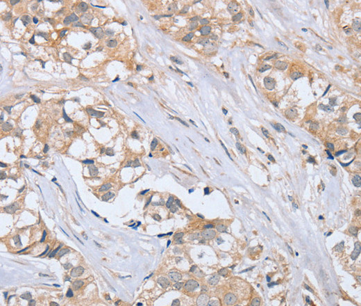 Immunohistochemistry of paraffin-embedded Human breast cancer tissue using PTPN4 Polyclonal Antibody at dilution 1:40