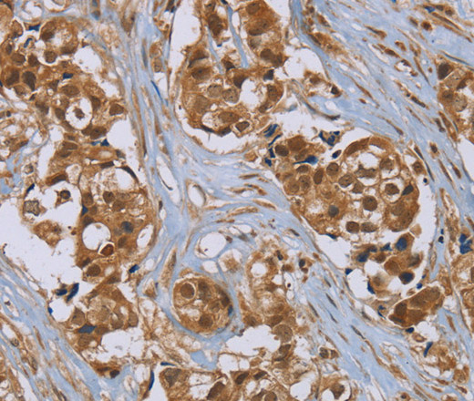 Immunohistochemistry of paraffin-embedded Human breast cancer using PUS10 Polyclonal Antibody at dilution of 1:45