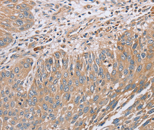 Immunohistochemistry of paraffin-embedded Human lung cancer tissue using RAB8B Polyclonal Antibody at dilution 1:45