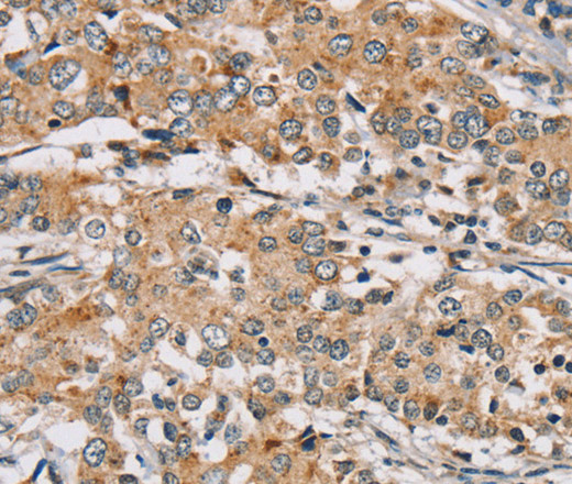 Immunohistochemistry of paraffin-embedded Human liver cancer tissue using RAB24 Polyclonal Antibody at dilution 1:45