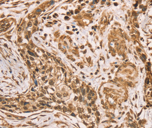 Immunohistochemistry of paraffin-embedded Human esophagus cancer using HIF1AN Polyclonal Antibody at dilution of 1:40