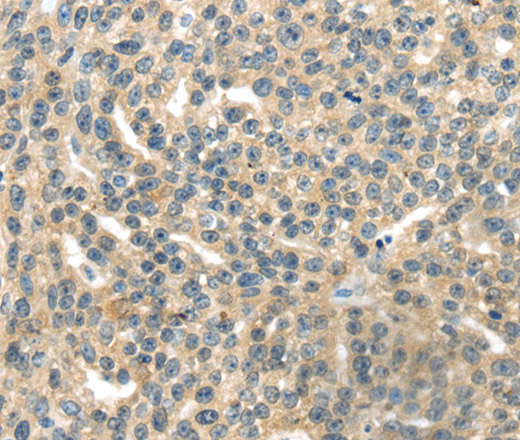 Immunohistochemistry of paraffin-embedded Human esophagus cancer tissue using RASA2 Polyclonal Antibody at dilution 1:45