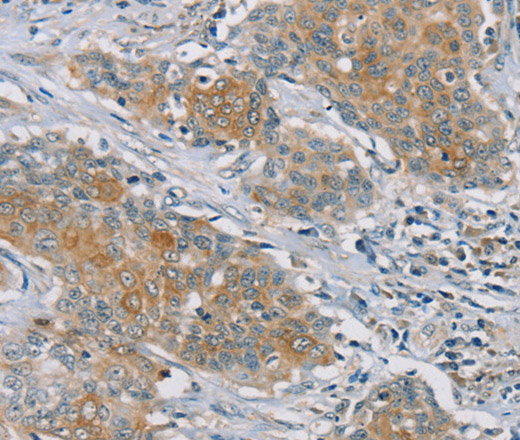 Immunohistochemistry of paraffin-embedded Human ovarian cancer tissue using RASA2 Polyclonal Antibody at dilution 1:45