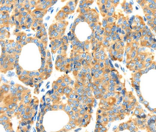 Immunohistochemistry of paraffin-embedded Human thyroid cancer tissue using RIPK4 Polyclonal Antibody at dilution 1:40