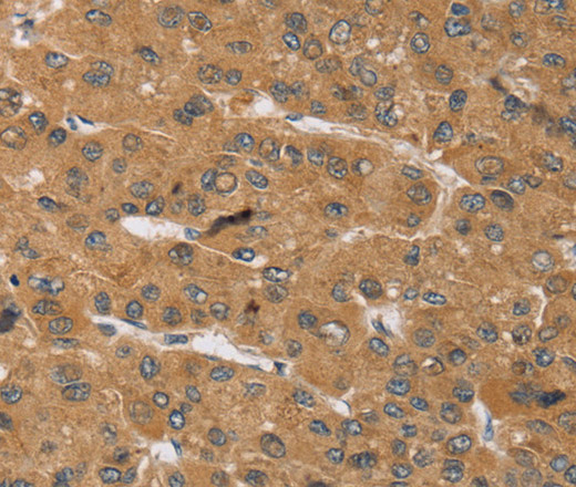 Immunohistochemistry of paraffin-embedded Human liver cancer tissue using KCNJ15 Polyclonal Antibody at dilution 1:40