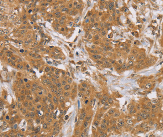 Immunohistochemistry of paraffin-embedded Human cervical cancer tissue using KCNJ15 Polyclonal Antibody at dilution 1:40