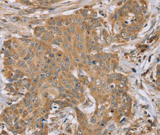 Immunohistochemistry of paraffin-embedded Human cervical cancer tissue using RNF148 Polyclonal Antibody at dilution 1:45