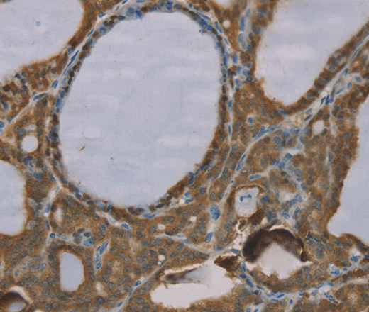 Immunohistochemistry of paraffin-embedded Human thyroid cancer tissue using S100A6 Polyclonal Antibody at dilution 1:35