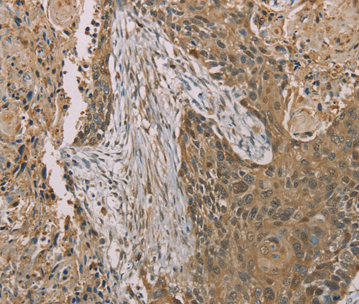 Immunohistochemistry of paraffin-embedded Human esophagus cancer tissue using S100A6 Polyclonal Antibody at dilution 1:35