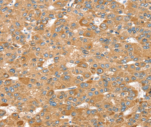 Immunohistochemistry of paraffin-embedded Human liver cancer using MORF4L1 Polyclonal Antibody at dilution of 1:35