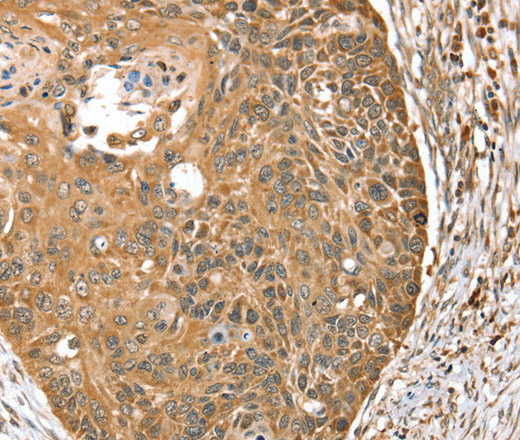 Immunohistochemistry of paraffin-embedded Human esophagus cancer using MORF4L1 Polyclonal Antibody at dilution of 1:35