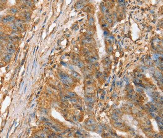 Immunohistochemistry of paraffin-embedded Human esophagus cancer tissue using SLC41A2 Polyclonal Antibody at dilution 1:45