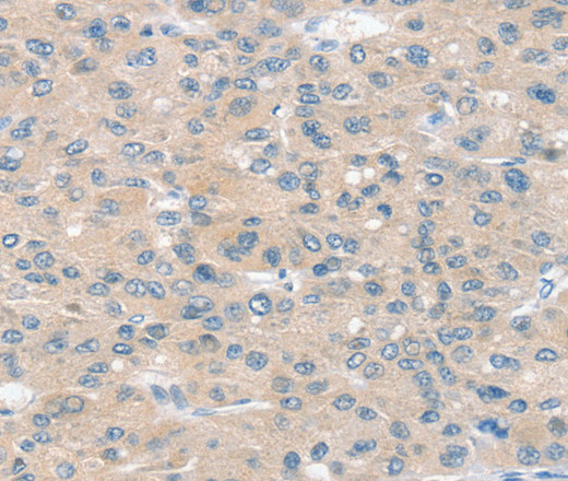 Immunohistochemistry of paraffin-embedded Human liver cancer using SLIT2 Polyclonal Antibody at dilution of 1:30