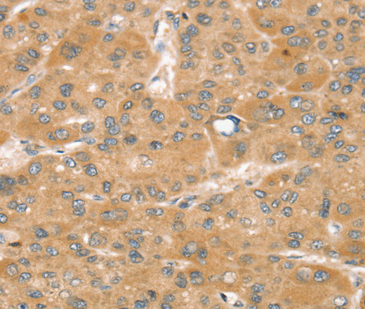 Immunohistochemistry of paraffin-embedded Human liver cancer using SNX2 Polyclonal Antibody at dilution of 1:40