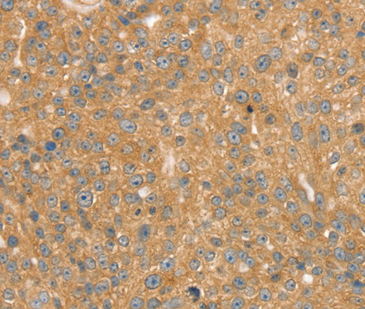 Immunohistochemistry of paraffin-embedded Human breast cancer using SNX2 Polyclonal Antibody at dilution of 1:40