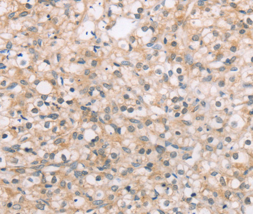 Immunohistochemistry of paraffin-embedded Human prostate cancer tissue using ROR1 Polyclonal Antibody at dilution 1:45