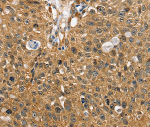 Immunohistochemistry of paraffin-embedded Human breast cancer using SORT1 Polyclonal Antibody at dilution of 1:35