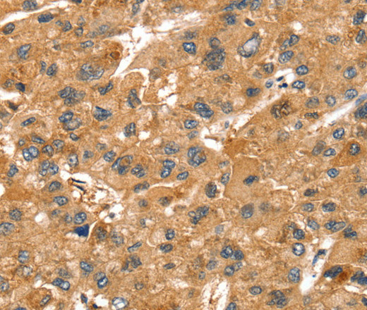 Immunohistochemistry of paraffin-embedded Human liver cancer tissue using SPTAN1 Polyclonal Antibody at dilution 1:40