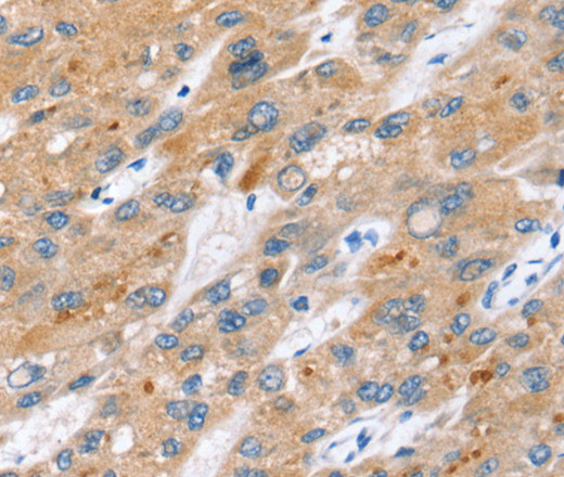 Immunohistochemistry of paraffin-embedded Human liver cancer tissue using ERVW-1 Polyclonal Antibody at dilution 1:45