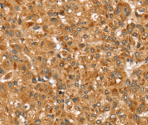 Immunohistochemistry of paraffin-embedded Human liver cancer using STX3 Polyclonal Antibody at dilution of 1:35