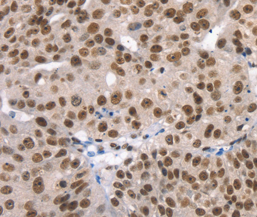 Immunohistochemistry of paraffin-embedded Human breast cancer using TAF15 Polyclonal Antibody at dilution of 1:35